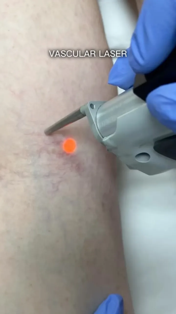Laser Hair Removal London – Iniya Clinic A laser hair removal session at Iniya Clinic in London, helping clients achieve smooth, hair-free skin with advanced technology.